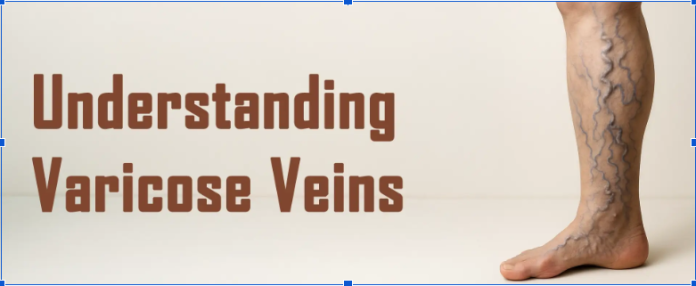varicose veins specialist in Ahmedabad varicose veins specialist in Ahmedabad